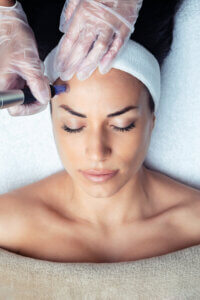 Microneedling bei Falten und Haarausfall, Microneedling für strahlende Haut, SoGsund